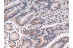 IHC-P analysis of Human Stomach Cancer Tissue, with DAB staining. (IL-10 antibody  (AA 19-178))