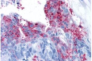 Human Colon Carcinoma (formalin-fixed, paraffin-embedded) stained with GPR124 antibody ABIN213374 at 11 ug/ml followed by biotinylated goat anti-rabbit IgG secondary antibody ABIN481713, alkaline phosphatase-streptavidin and chromogen. (GPR124 antibody  (N-Term))