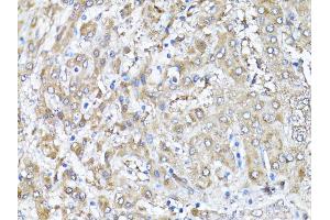 Immunohistochemistry of paraffin-embedded human liver using SNAI1 antibody (ABIN4905248) at dilution of 1:100 (40x lens). (SNAIL antibody)