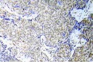 Immunohistochemistry (IHC) analyzes of p-GATA-1 antibody in paraffin-embedded human lung adenocarcinoma tissue. (GATA1 antibody  (pSer310))
