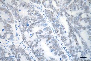 Immunohistochemistry was performed on paraffin-embedded human sigmoid colon carcinoma using SMC3 antibody (ABIN7800448), 1:200). (Recombinant SMC3 antibody)