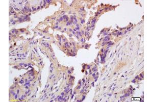 Formalin-fixed and paraffin embedded human colon carcinoma labeled with Rabbit Anti ChRM2 Polyclonal Antibody, Unconjugated (ABIN668646) at 1:200 followed by conjugation to the secondary antibody and DAB staining (Muscarinic Acetylcholine Receptor M2 antibody  (AA 168-250))