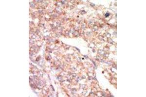 Formalin-fixed and paraffin-embedded human cancer tissue reacted with the primary antibody, which was peroxidase-conjugated to the secondary antibody, followed by AEC staining. (EPHA1 antibody  (N-Term))