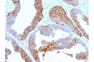 Formalin-fixed, paraffin-embedded human Prostate Carcinoma stained with HLA-DR Mouse Monoclonal Antibody (TAL 1B5). (HLA-DR antibody)
