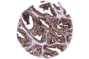 Prostate Prostatic adenocarcinoma Gleason 448 with strong diffuse PSAP positivity (Recombinant Prosaposin antibody)