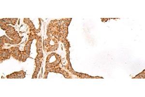 Immunohistochemistry of paraffin-embedded Human thyroid cancer tissue using GBGT1 Polyclonal Antibody at dilution of 1:40(x200) (GBGT1 antibody)