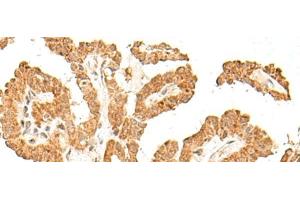 Immunohistochemistry of paraffin-embedded Human thyroid cancer tissue using FANCB Polyclonal Antibody at dilution of 1:60(x200) (FANCB antibody)