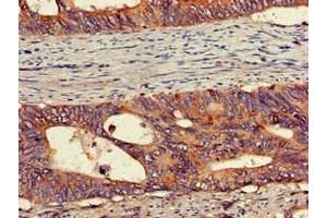 Immunohistochemistry of paraffin-embedded human colon cancer using ABIN7175913 at dilution of 1:100 (PEPD antibody  (AA 258-395))