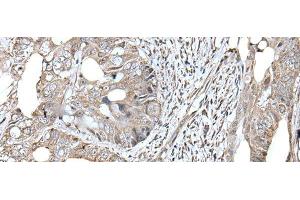 Immunohistochemistry of paraffin-embedded Human colorectal cancer tissue using RAD54B Polyclonal Antibody at dilution of 1:45(x200) (RAD54B antibody)