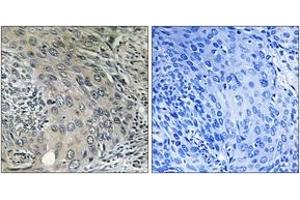 Immunohistochemistry analysis of paraffin-embedded human cervix carcinoma tissue, using COPZ1 Antibody.