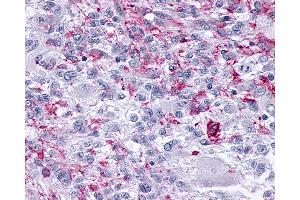 Anti-OPRM1 / Mu Opioid Receptor antibody IHC of human Brain, Glioblastoma. (Mu Opioid Receptor 1 antibody  (C-Term))