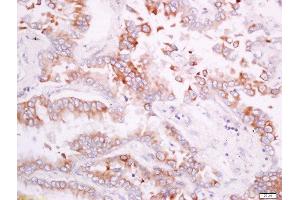 Paraformaldehyde-fixed, paraffin embedded human lung carcinoma tissue, Antigen retrieval by boiling in sodium citrate buffer(pH6) for 15min, Block endogenous peroxidase by 3% hydrogen peroxide for 30 minutes, Blocking buffer (normal goat serum) at 37°C for 20min, Antibody incubation with Rabbit Anti-CD300A/C Polyclonal Antibody, Unconjugated  at 1:200 overnight at 4°C, followed by a conjugated secondary and DAB staining (CD300A/ C (AA 20-70) antibody)