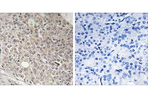 Peptide - +Immunohistochemistry analysis of paraffin-embedded human prostate carcinoma tissue using AMOTL1 antibody. (AMOTL1 antibody)