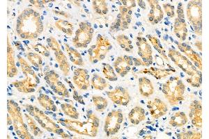ABIN6264069 and ABIN6273289 at 1/100 staining Human kidney cancer and adjacent normal tissues by IHC-P. (PCMT1 antibody  (Internal Region))