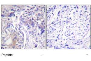 Immunohistochemistry analysis of paraffin-embedded human breast carcinoma tissue using ADD1 polyclonal antibody . (alpha Adducin antibody)