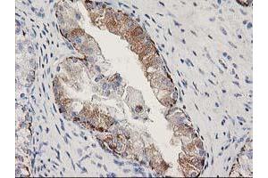 Immunohistochemical staining of paraffin-embedded Adenocarcinoma of Human ovary tissue using anti-MGLL mouse monoclonal antibody. (MGLL antibody)