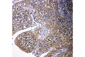 Anti-NOX2/gp91phox antibody, IHC(P) IHC(P): Human Intestinal Cancer Tissue (CYBB antibody  (Middle Region))