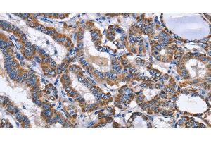 Immunohistochemistry of paraffin-embedded Human thyroid cancer using INTS10 Polyclonal Antibody at dilution of 1:50 (INTS10 antibody)