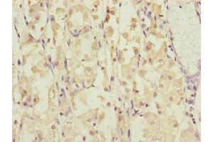 Immunohistochemistry of paraffin-embedded human gastric cancer using ABIN7149316 at dilution of 1:100