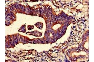 Immunohistochemistry of paraffin-embedded human colon cancer using ABIN7151278 at dilution of 1:100 (TRIM4 antibody  (AA 1-118))