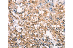 Immunohistochemistry of Human liver cancer using LATS2 Polyclonal Antibody at dilution of 1:30 (LATS2 antibody)
