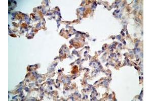 Rat lung cancer tissue stained by Rabbit Anti-CRAMP (Mouse) Antibody (Cathelicidin antibody  (AA 140-173))