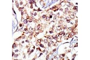 IHC analysis of FFPE human breast carcinoma tissue stained with the c-Src antibody (Src antibody  (AA 1-30))