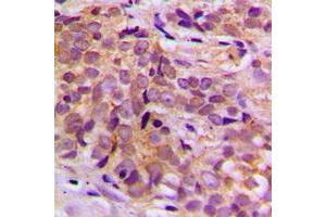 Immunohistochemical analysis of CEP170 staining in human breast cancer formalin fixed paraffin embedded tissue section. (CEP170 antibody  (Center))