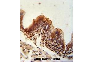 TXNDC6 antibody (Center) immunohistochemistry analysis in formalin fixed and paraffin embedded human lung carcinoma followed by peroxidase conjugation of the secondary antibody and DAB staining. (NME9 antibody  (Middle Region))