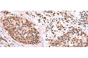 Immunohistochemistry of paraffin-embedded Human esophagus cancer tissue using SF3B3 Polyclonal Antibody at dilution of 1:70(x200) (SF3B3 antibody)