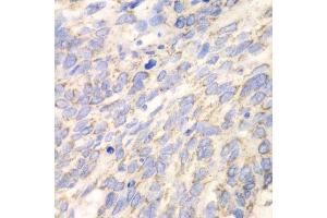 Immunohistochemistry of paraffin-embedded human esophageal cancer using DLD antibody.