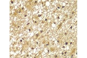 Immunohistochemistry of paraffin-embedded Human brain cancer using PIK3R3 Polyclonal Antibody at dilution of 1:100 (40x lens). (PIK3R3 antibody)