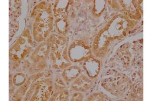 Immunohistochemistry of paraffin-embedded human colon cancer using ABIN7174308 at dilution of 1:100