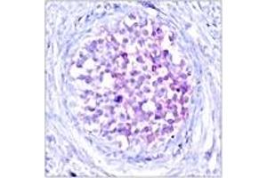 Immunohistochemistry analysis of paraffin-embedded human breast carcinoma, using C-RAF (Phospho-Ser259) Antibody. (RAF1 antibody  (AA 225-274))