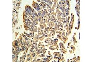 HSP27 antibody IHC analysis in formalin fixed and paraffin embedded human lung carcinoma.