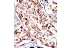 Formalin-fixed and paraffin-embedded human cancer tissue reacted with the primary antibody, which was peroxidase-conjugated to the secondary antibody, followed by DAB staining. (Src antibody  (N-Term))