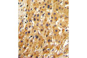 Formalin-fixed and paraffin-embedded human hepatocarcinoma with RT Antibody (N-term), which was peroxidase-conjugated to the secondary antibody, followed by DAB staining. (APRT antibody  (N-Term))