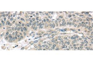 Immunohistochemistry of paraffin-embedded Human lung cancer using THAP4 Polyclonal Antibody at dilution of 1/30 (THAP4 antibody)