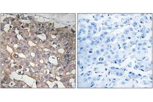 Immunohistochemistry analysis of paraffin-embedded human breast carcinoma tissue, using STMN1 (Ab-62) Antibody. (Stathmin 1 antibody  (AA 26-75))