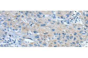 Immunohistochemistry of paraffin-embedded Human liver cancer using TNIP1 Polyclonal Antibody at dilution of 1/35 (TNIP1 antibody)