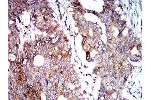 Immunohistochemical analysis of paraffin-embedded rectum cancer tissues using BNIP3 mouse mAb with DAB staining. (BNIP3 antibody  (AA 50-155))