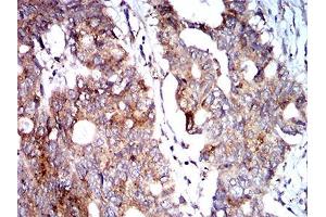 Immunohistochemical analysis of paraffin-embedded rectum cancer tissues using BNIP3 mouse mAb with DAB staining.