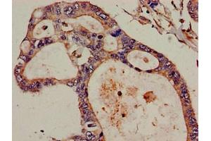 Immunohistochemistry of paraffin-embedded human pancreatic cancer using ABIN7152297 at dilution of 1:100 (DIS3 antibody  (AA 30-187))
