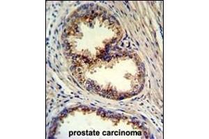 Formalin-fixed and paraffin-embedded human prostate carcinoma reacted with GOLPH3 Antibody (N-term), which was peroxidase-conjugated to the secondary antibody, followed by DAB staining. (GOLPH3 antibody  (N-Term))