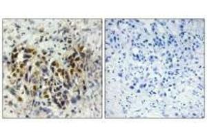 Immunohistochemistry analysis of paraffin-embedded human breast carcinoma tissue, using IRX3 antibody. (IRX3 antibody)