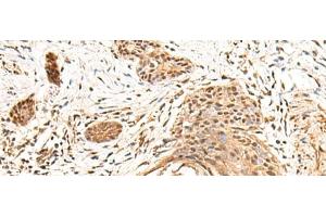 Immunohistochemistry of paraffin-embedded Human esophagus cancer tissue using KCTD13 Polyclonal Antibody at dilution of 1:55(x200) (KCTD13 antibody)