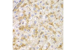 Immunohistochemistry of paraffin-embedded human liver cancer using ACTN1 antibody. (ACTN1 antibody)
