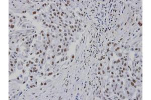 IHC-P Image Immunohistochemical analysis of paraffin-embedded human lung cancer patient tumor, using RPA 14 kDa subunit , antibody at 1:100 dilution. (RPA3 antibody)