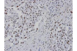 IHC-P Image Immunohistochemical analysis of paraffin-embedded human lung cancer patient tumor, using RPA 14 kDa subunit , antibody at 1:100 dilution. (RPA3 antibody)