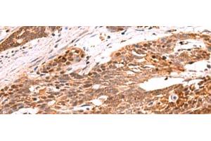 Immunohistochemistry of paraffin-embedded Human esophagus cancer tissue using RRP8 Polyclonal Antibody at dilution of 1:80(x200) (RRP8 antibody)